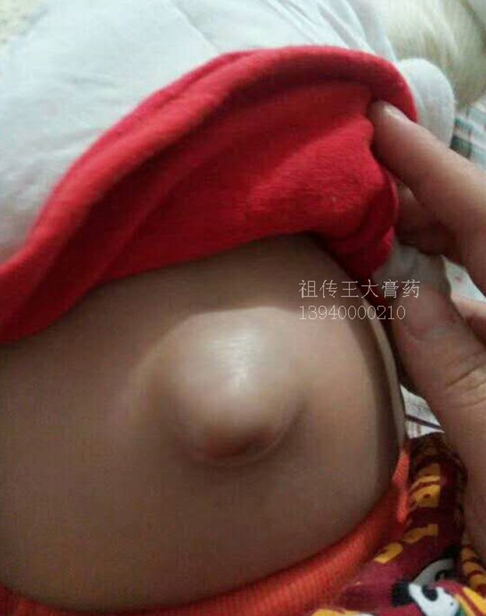 脐疝、王大膏药