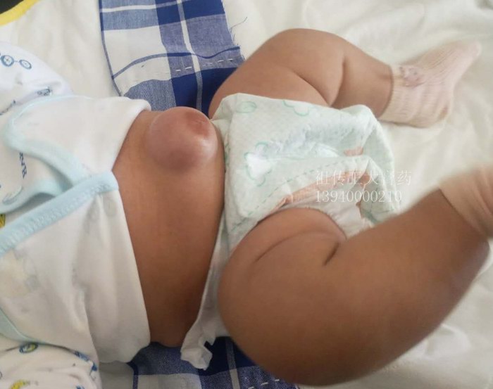 脐疝、王大膏药