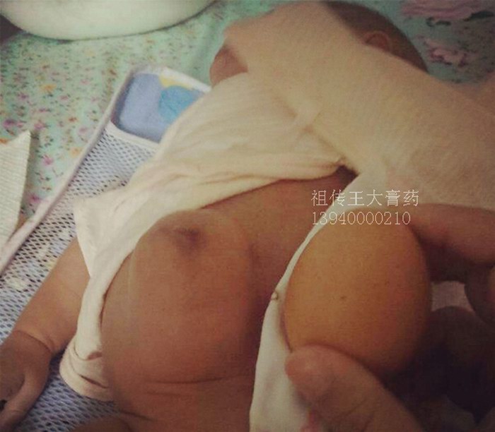 脐疝、王大膏药