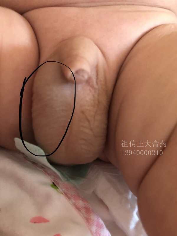 鞘膜积液、水疝