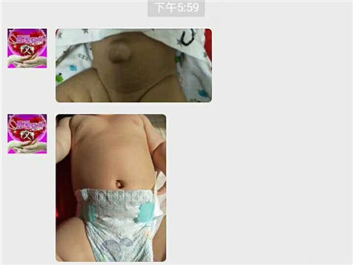 脐疝、王大膏药