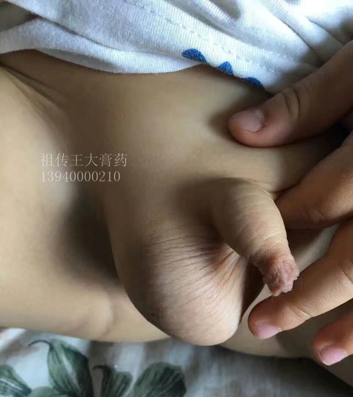 鞘膜积液、腹股沟斜疝、疝气